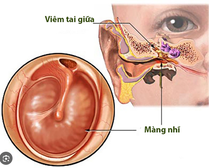 Viêm tai giữa cấp dai dẳng và tái phát ở trẻ em