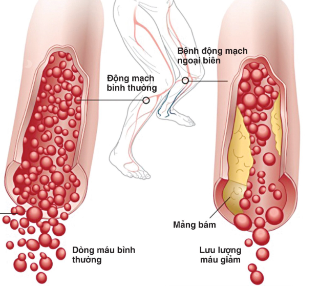 Bệnh động mạch chi dưới