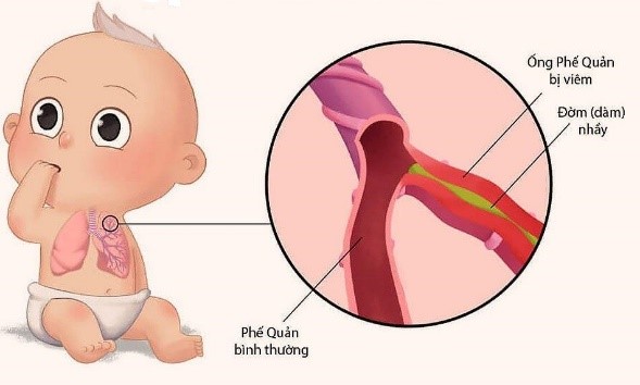 Chẩn đoán và điều trị dự phòng Hen phế quản trẻ em