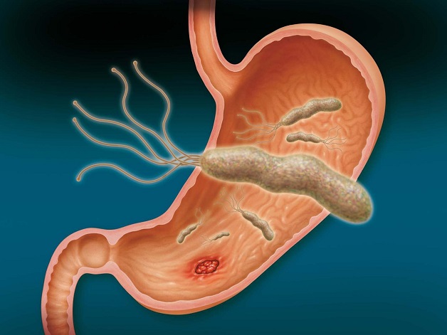 Helicobacter Pylori trong dạ dày