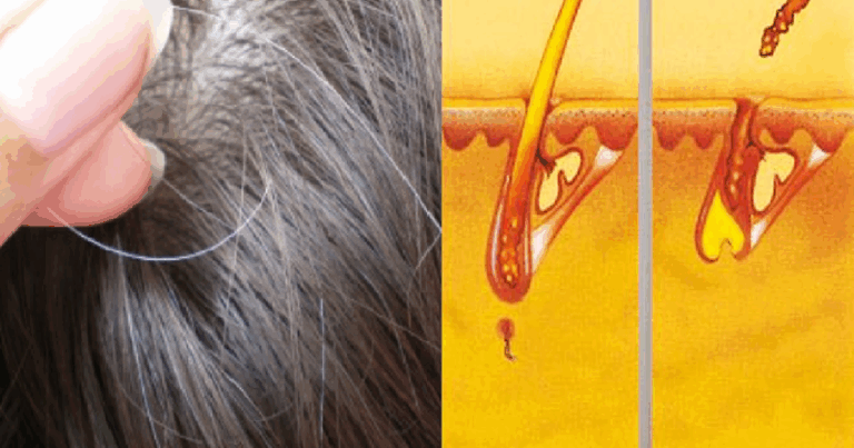 TÓC BẠC & UNG THƯ/ GREY HAIR & CANCER