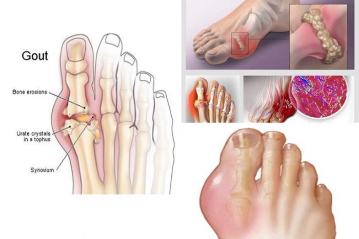 CHUYÊN ĐỀ: QUẢN LÝ TOÀN DIỆN BỆNH GOUT