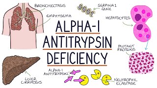 alpha-1 antitrypsin deficiency (AATD) là gì? Ai nên được tầm soát thiếu hụt alpha-1 antitrypsin (AATD)? /What is AATD? Who should be screened for AATD)?
