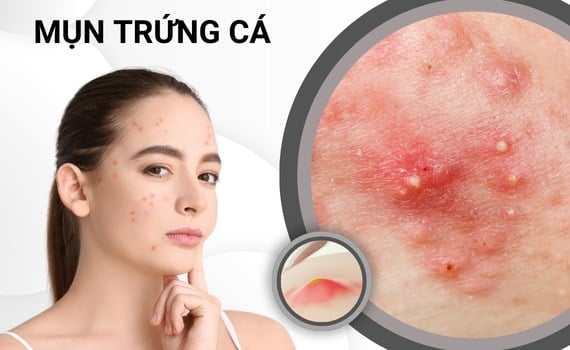 CHUYÊN ĐỀ: ĐIỀU TRỊ MỤN TRỨNG CÁ VÀ CHĂM SÓC DA