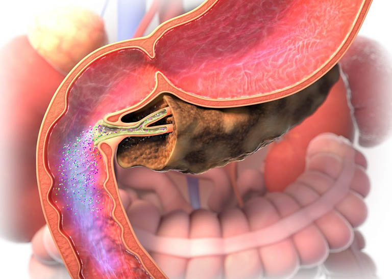 CHUYÊN ĐỀ: CẬP NHẬT ĐIỀU TRỊ CÁC BỆNH LÝ ĐƯỜNG TIÊU HOÁ THƯỜNG GẶP